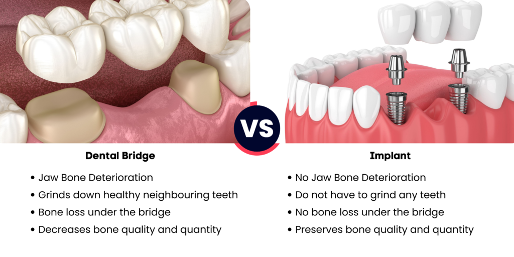 No Jaw Bone Deterioration Do not have to grind any teeth No bone loss under the bridge Preserves bone quality and quantity